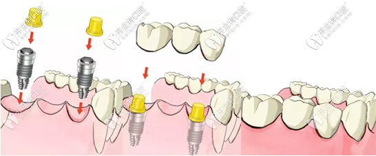 陽(yáng)江種植牙價(jià)格 陽(yáng)江種植牙價(jià)格