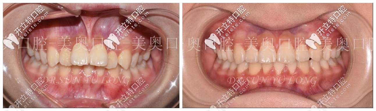 齙牙矯正前后對比圖