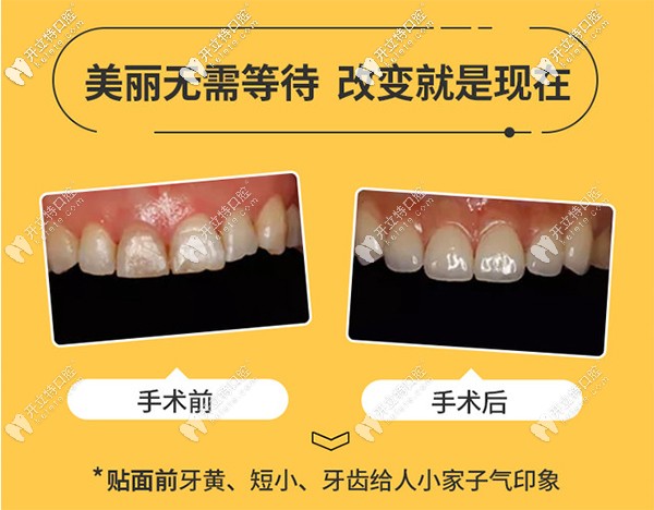 為美發(fā)問：重慶渝中區(qū)的美奧口腔做美加超薄牙貼面如何？