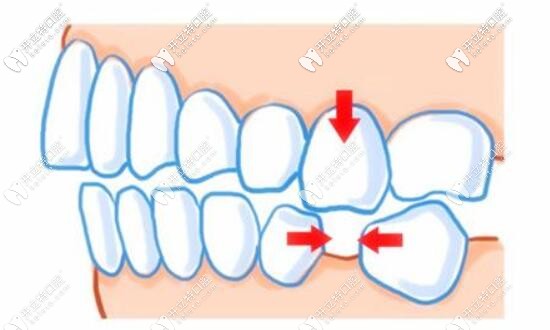 缺牙不種的后果 缺牙不種的后果