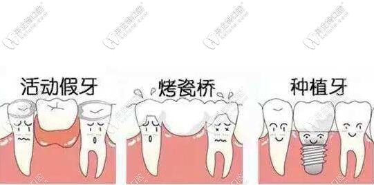 缺牙不種的后果 缺牙不種的后果