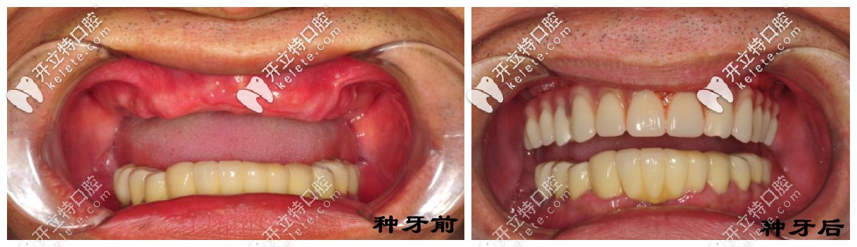 種半口牙前后對(duì)比