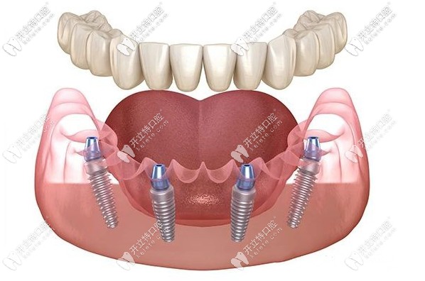 “我太想知道南京做all-on-4種植牙哪家牙科好了！”