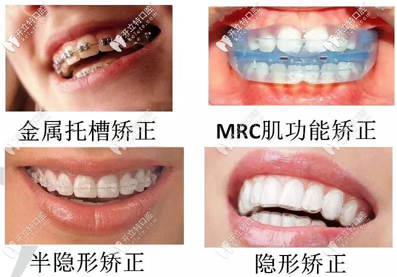 成人和兒童牙齒矯正的價格