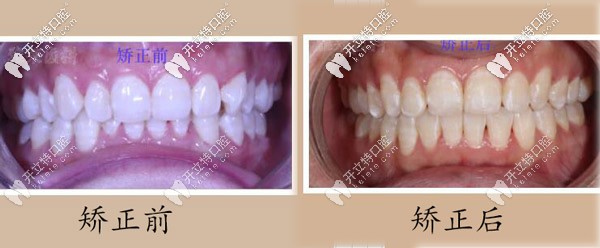 李洋醫(yī)生矯正案例