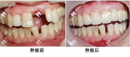 種植牙前后對(duì)比