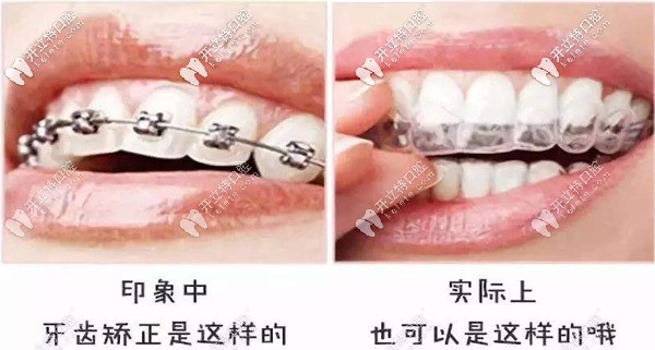 告別鋼牙妹，別錯過隱形矯正哦