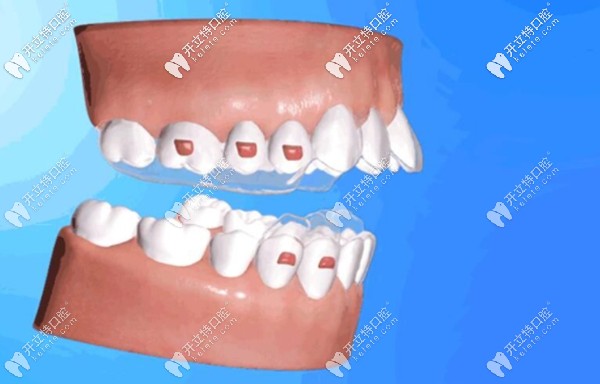 a6隱形sgtb矯治器