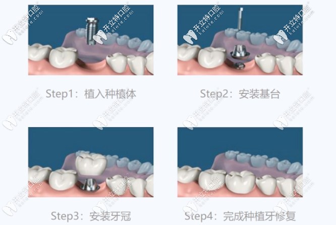 種植牙的簡(jiǎn)單流程