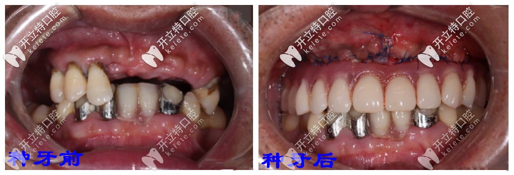 穿顴手術(shù)的種牙前后對比