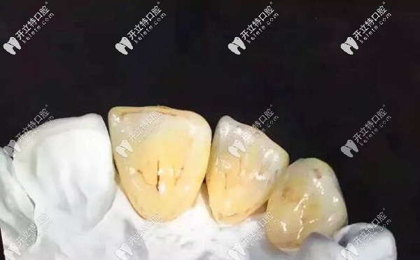 1000元的全瓷牙和1500的差別