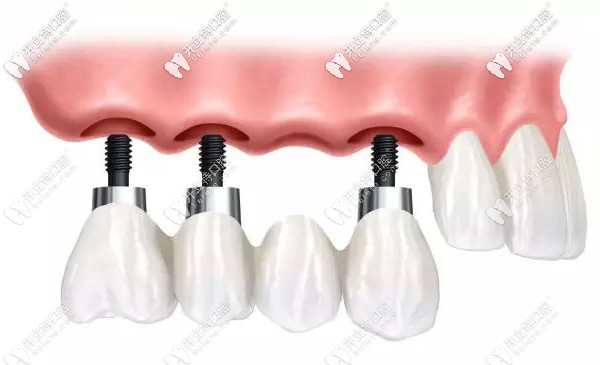 王鋒醫(yī)生尤為擅長牙齒種植技術(shù) 王鋒醫(yī)生尤為擅長牙齒種植技術(shù)