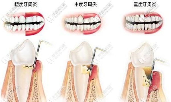 上海哪里有丹麥水冷激光治療，大概需要多少費(fèi)用？