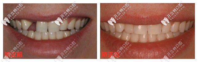 矯正前后對(duì)比