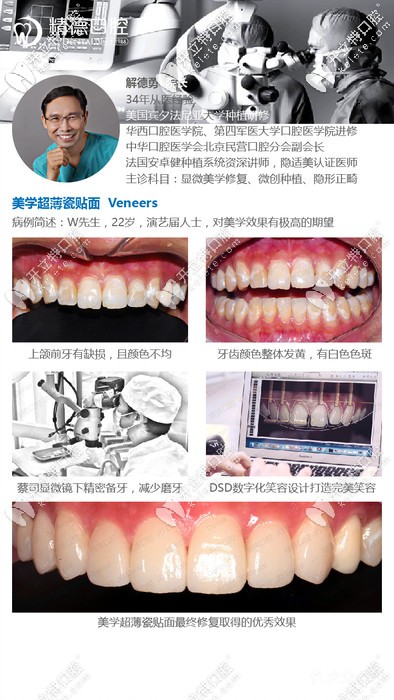 精德口腔解德勇院長(zhǎng)的牙齒貼面案例 精德口腔解德勇院長(zhǎng)的牙齒貼面案例