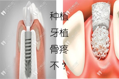 天哪！種植牙填骨粉太疼了？上門牙種植一定要植骨粉嗎