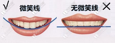 微笑線設(shè)計(jì)前后對比圖