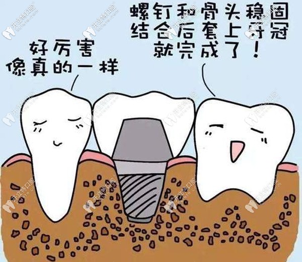 瑞典諾貝爾Nobel種植體