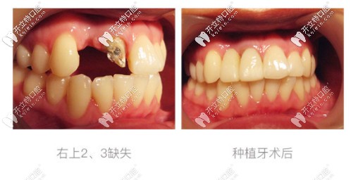 種牙前后對(duì)比