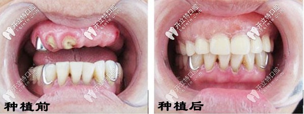 種牙前后對(duì)比