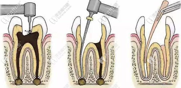 補(bǔ)牙打樁好還是不打樁好