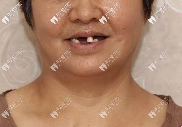 老媽種牙前的樣子