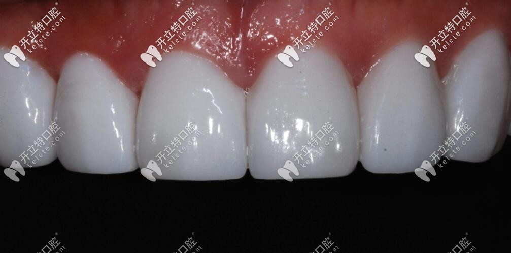 瑞士珍珠白納米水晶瓷貼面怎么樣？和玻璃瓷貼面哪個(gè)更好