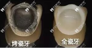 烤瓷牙和全瓷牙的區(qū)別