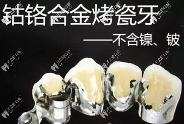 鈷鉻烤瓷牙現(xiàn)在還有人用嗎?別沖動!先了解一下優(yōu)缺點