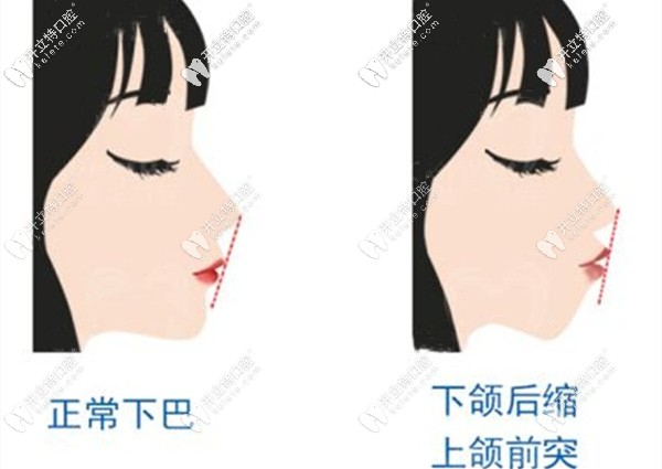 牙齒矯正可以改善上頜前突下頜后縮的癥狀
