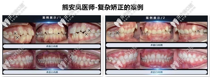 熊安鳳-復(fù)雜正畸案例分享