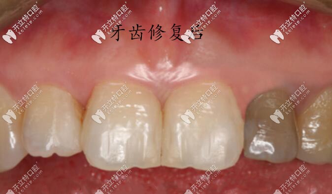 牙齒修復(fù)后