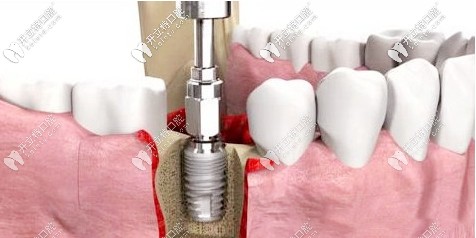 種植牙圖片