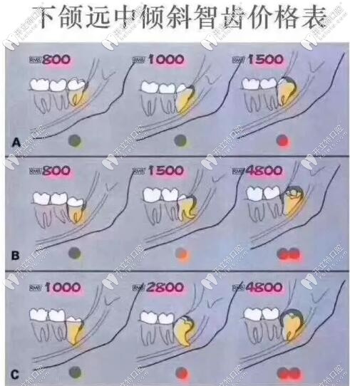 拔一顆智齒多少錢