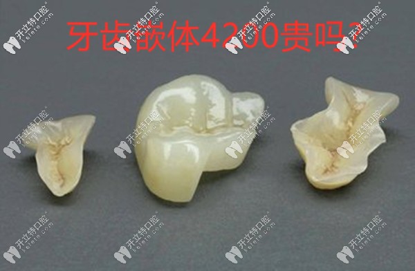 牙齒嵌體4200貴嗎?只能說(shuō)嵌體補(bǔ)牙材質(zhì)不同價(jià)格也有差異哦
