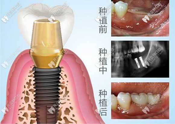 我的種植牙前中后過(guò)程圖