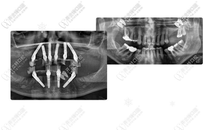 用德國sky種植體做全口即刻負(fù)重種植牙怎么樣，價(jià)格如何？