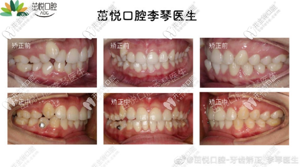 李琴醫(yī)生的案例