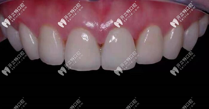 做了10顆明星納米貼面后的效果圖