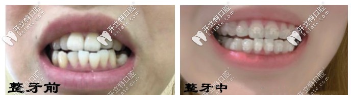 整牙前后對(duì)比