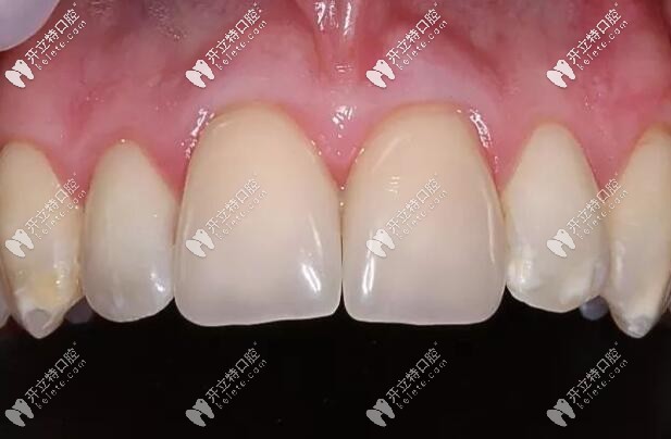 前牙修復(fù)