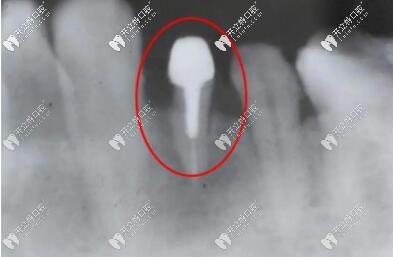 牙齒打樁后的樣子