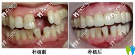 詹世全副種植牙案例