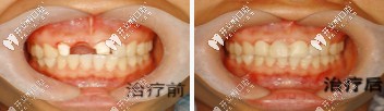 惠安齒科種植牙前后對(duì)比