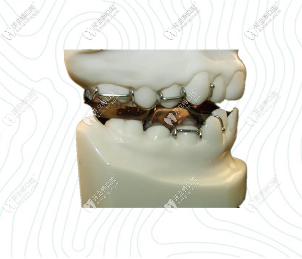 快來看看twinblock矯治原理，這些注意事項可是很重要哦！