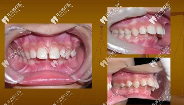 twinblock矯治適應(yīng)癥