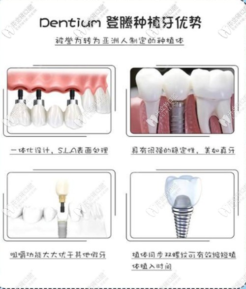 韓國登騰種植牙優(yōu)勢