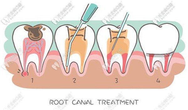 根管治療不可怕哦