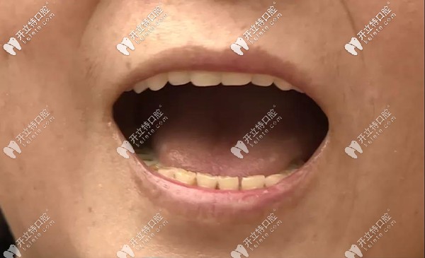 成都圣貝全口種植牙