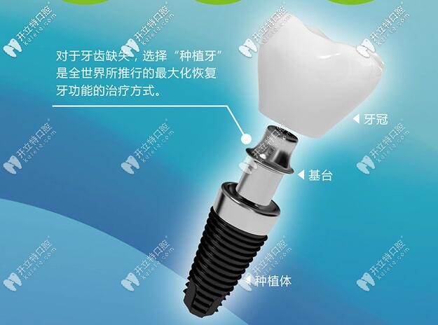 牙齒壞掉可以用種植牙替換